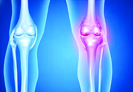 Osteomielitis, Penyakit Infeksi Tulang