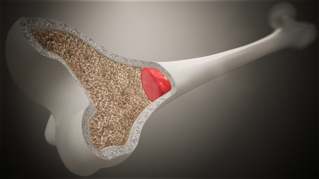 Mengenal Sumsum Tulang dan Fungsinya